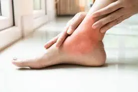 Control Gout Image